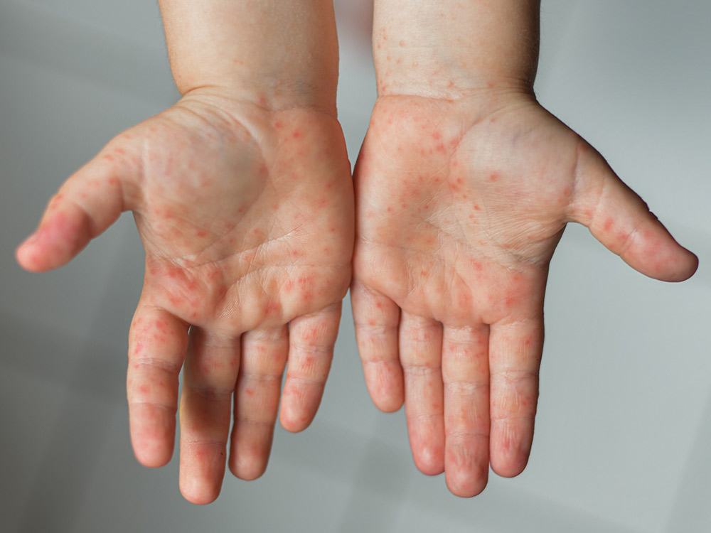 Hand, foot & mouth disease