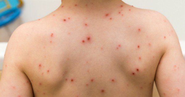 Chickenpox vaccine is important