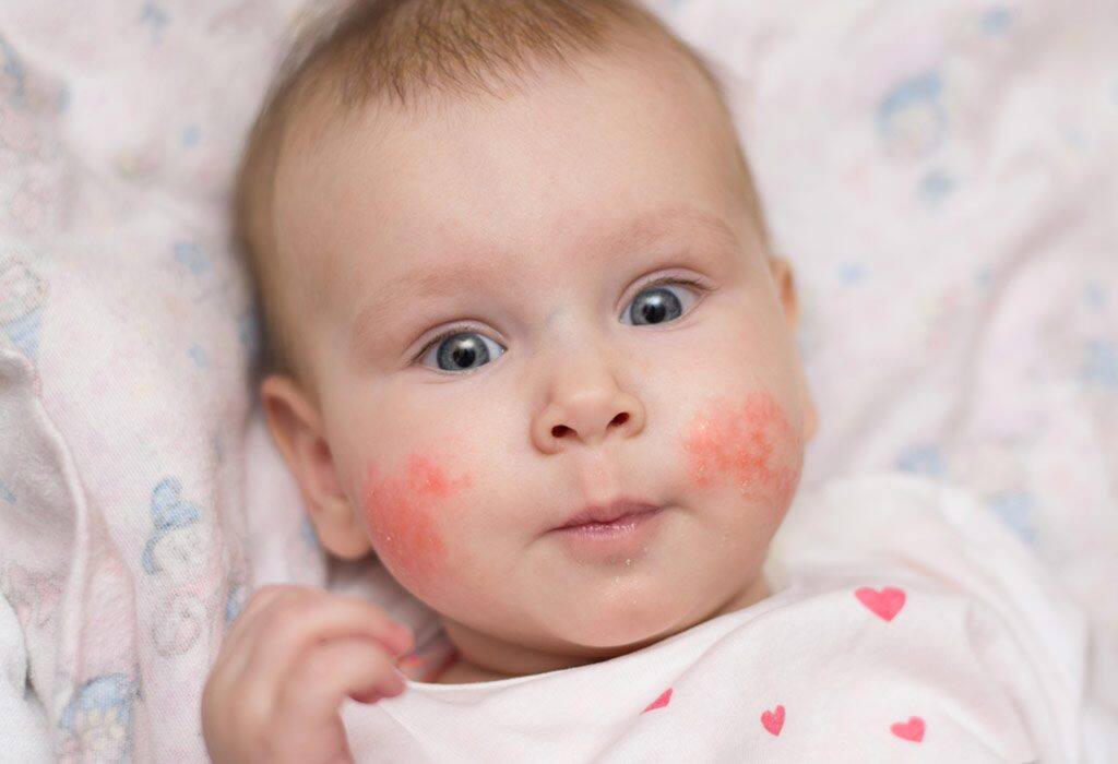 Common Infant Skin Problems
