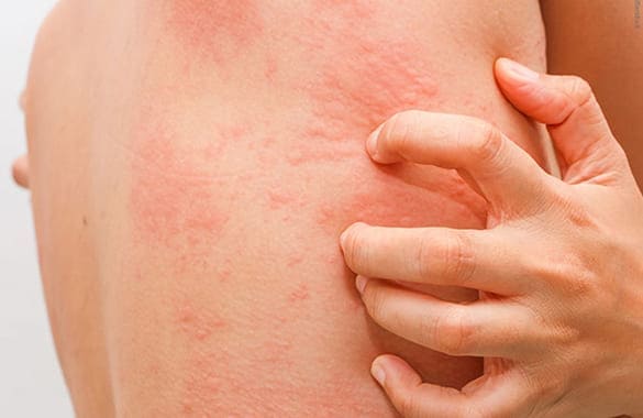 Hives treatment for Children in Vadodara
